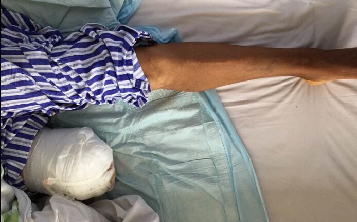 【保山安利醫(yī)院】濫用民間草藥，造成截肢后果