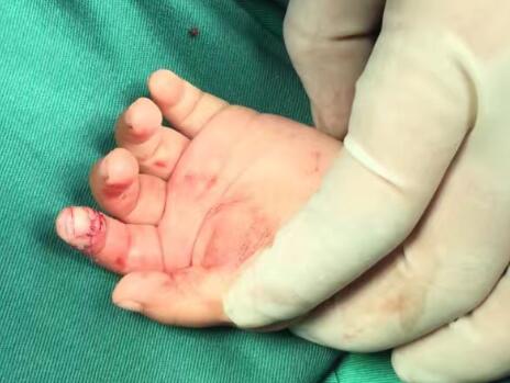 你相信嗎？兔子能把手指給咬斷了！