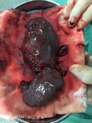 14歲男孩玩耍摔倒，脾臟破裂，險些喪命！