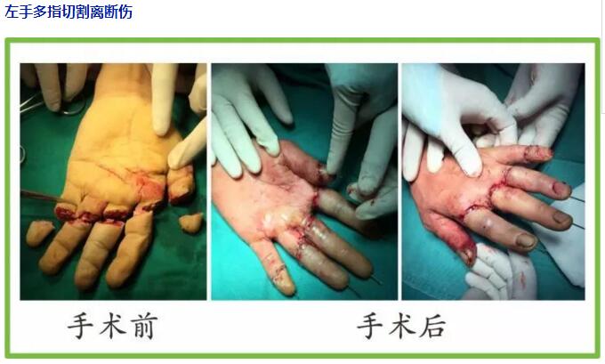 同樣斷指不同結(jié)局—斷指保存和康復(fù)指導(dǎo)