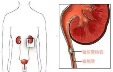輸尿管結(jié)石，到底能不能保守治療？