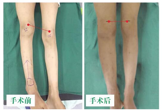 女孩墜梯右腿縮短5cm，幸得醫(yī)生及時診治恢復(fù)正常腿型