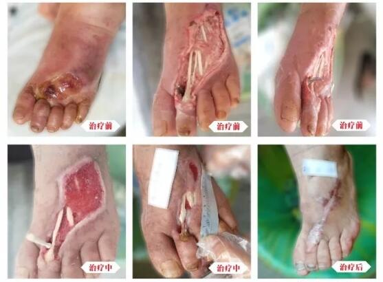 糖尿病并發(fā)癥有多可怕，及時(shí)治療糖尿病足避免截肢！