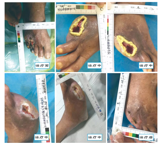 介入治療糖尿病足，您聽說過沒？