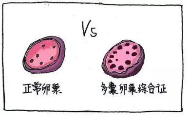 多囊卵巢綜合征與生酮飲食，您不知道的“減肥效果”