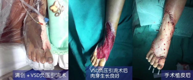 車禍猛如虎，救治如“華佗” ，手術(shù)＋康復(fù)，8歲小女孩車禍后日漸康復(fù)行走