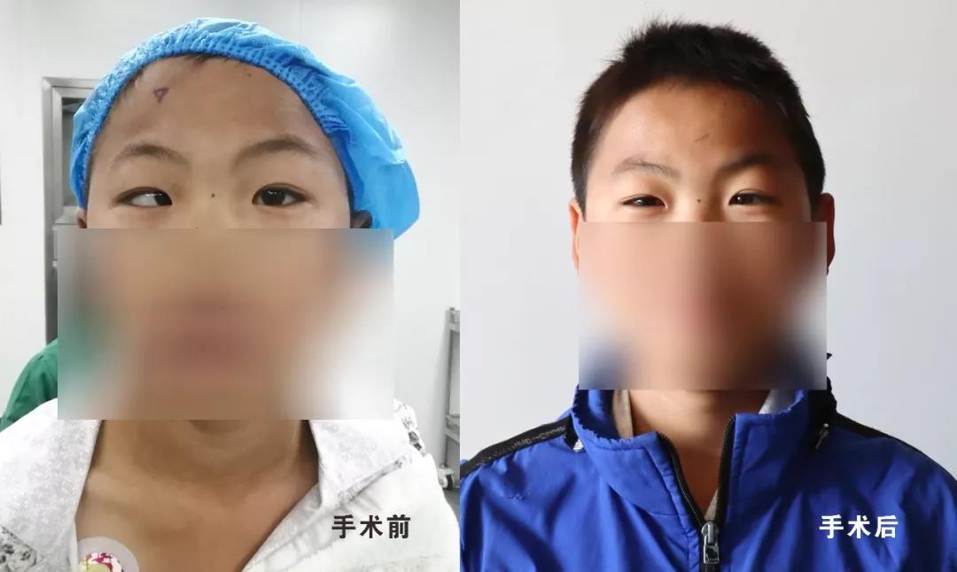 【保山安利醫(yī)院】兒童斜視手術(shù)再也不用跑省城了！
