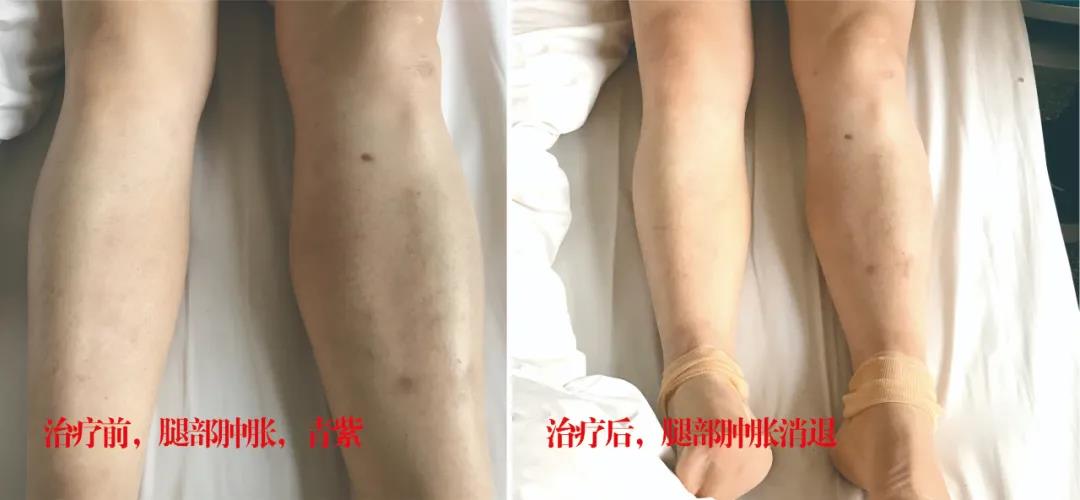 下肢靜脈血栓多年頑疾反復(fù)腫痛——疾病不容等待，早治療，早健康！