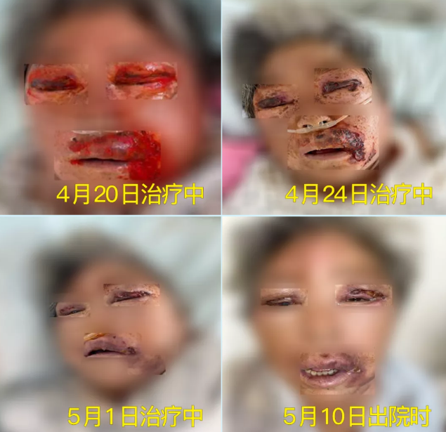 膿毒血癥（急性頜面部蜂窩組織炎）多學(xué)科聯(lián)合會診，幫助患者成功治愈！