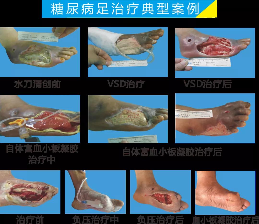 截肢、失明，甚至……，我們要做的是將糖尿病并發(fā)癥遏制在搖籃里！