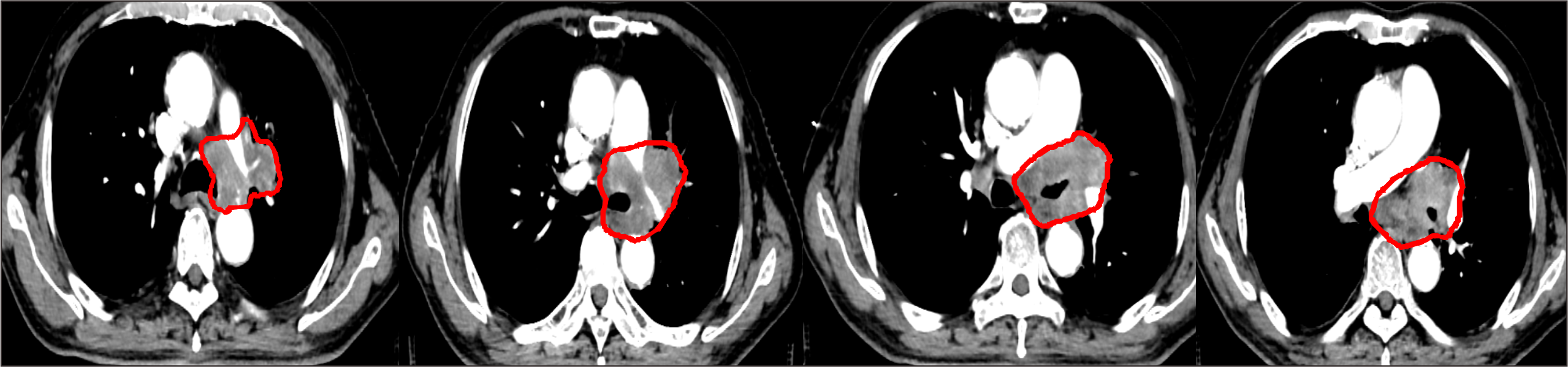 【保山安利醫(yī)院】對于局部晚期非小細胞肺癌患者，手術不能做，化療打不動，該怎么辦？