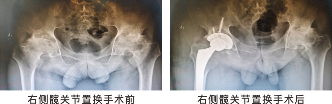 【保山安利醫(yī)院】長(zhǎng)期飲酒導(dǎo)致雙側(cè)股骨頭壞死，髖關(guān)節(jié)置換后重獲運(yùn)動(dòng)功能！