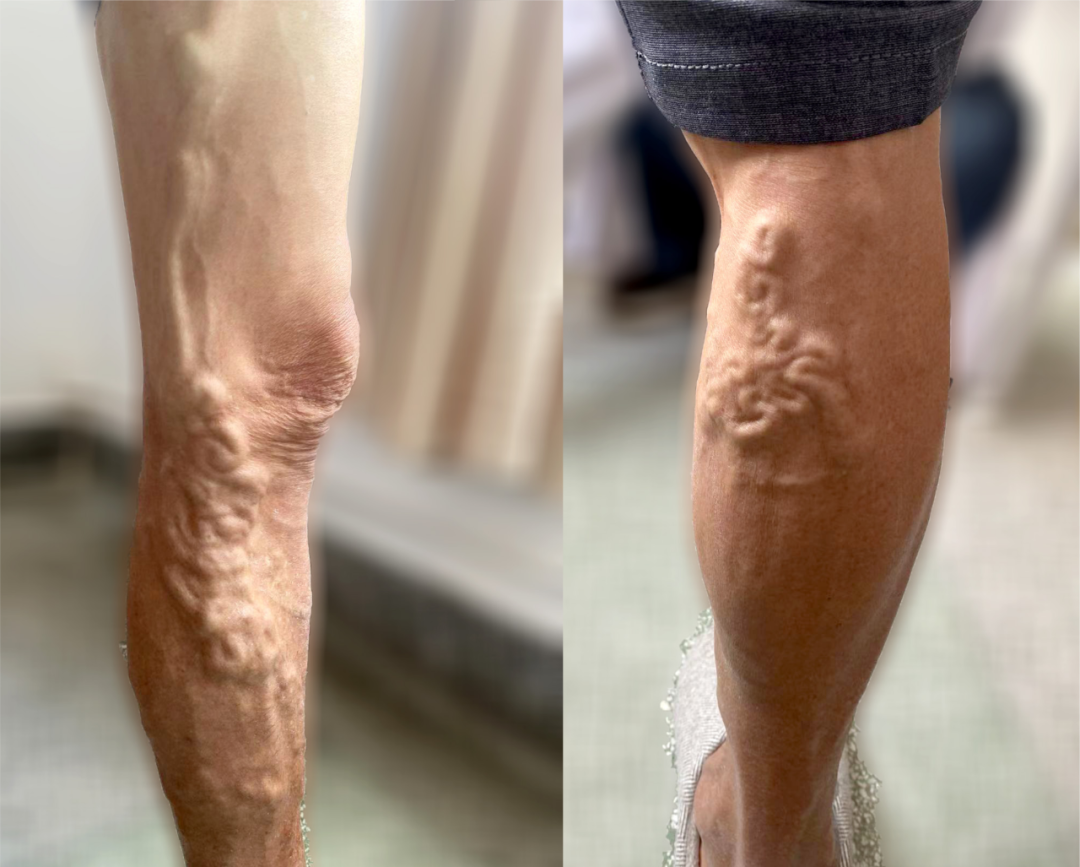 【保山安利醫(yī)院】大隱靜脈高位結(jié)扎＋剝脫術(shù)幫你解決大隱靜脈曲張“蚯蚓狀”紋路腿！