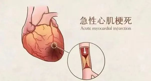 【保山安利醫(yī)院】11月20日“心梗救治日” 時間就是心肌，時間就是生命！