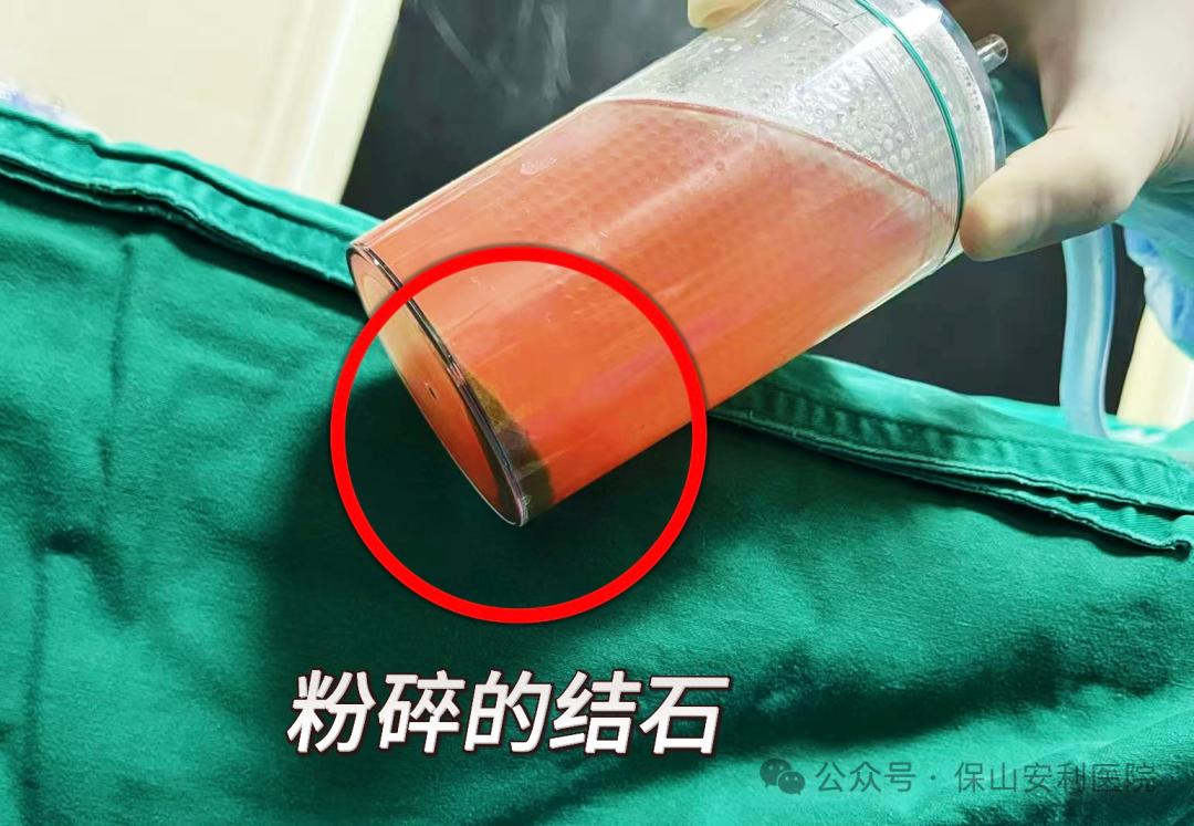 科普丨泌尿結(jié)石“克星”鈥激光碎石術(shù)，手術(shù)動圖揭秘全過程！
